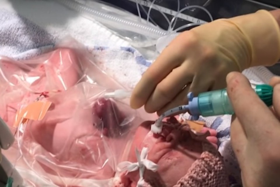 В Великобритании родилась девочка с сердцем наружу. Фото: кадр видео с YouTube