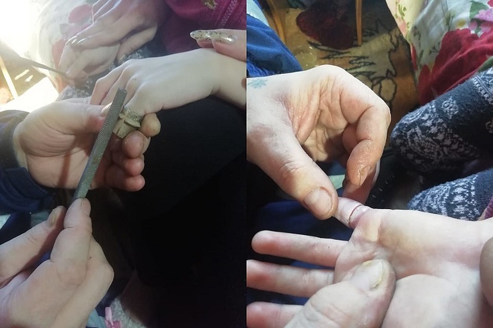 Девочке освободили палец с помощью специального напильника. Фото: https://vk.com/assnso