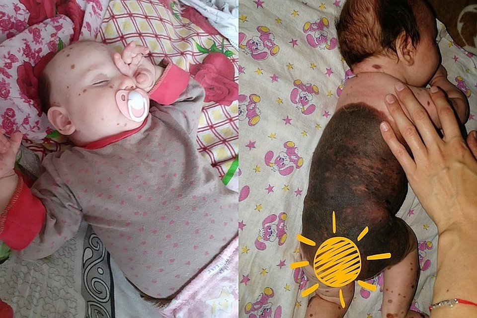 Гигантская родина занимает больше 80 % тела шестимесячной Вики Хвостанцевой. Фото: страница Марии Хвостанцевой ВКонтакте