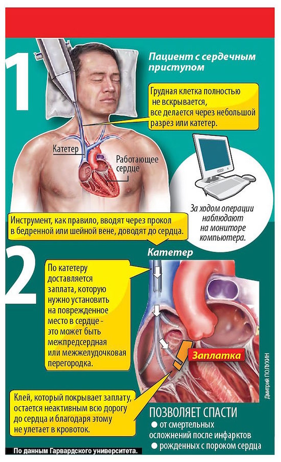 Как делают заплатки на сердце.