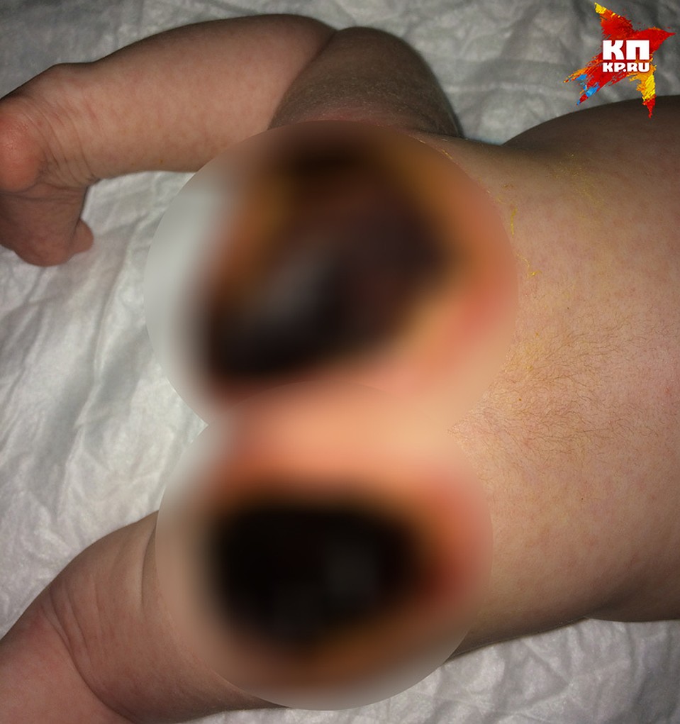 Родные малышки не верят, что такие ожоги девочка получила из-за грелки.