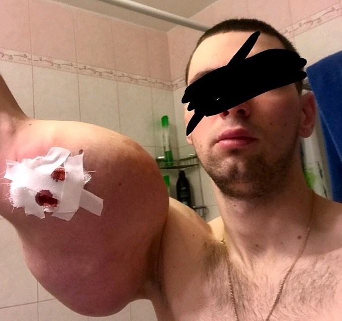 Через несколько месяцев после операции, Кирилл начал жаловаться на боль, повышение температуры и даже обмороки. Фото: Личная страничка героя публикации в соцсети