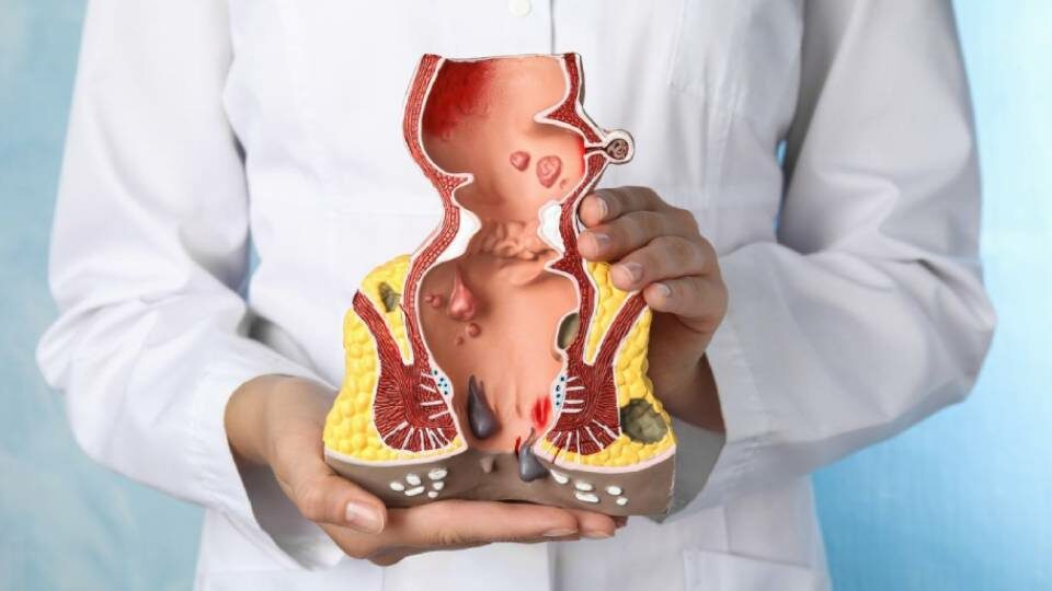 9 методов лечения геморроя у женщин и мужчин