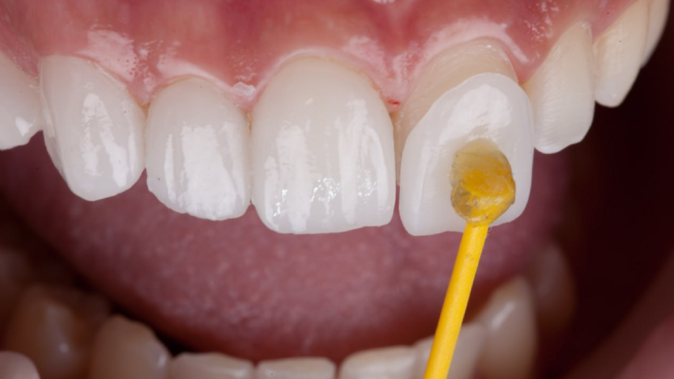 Как убрать щель между зубами