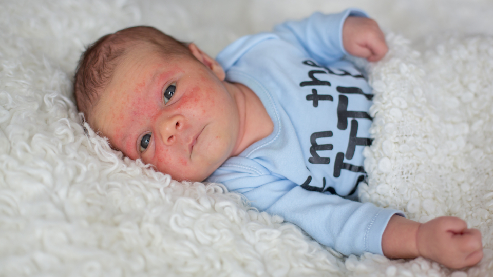 Розеола у детей