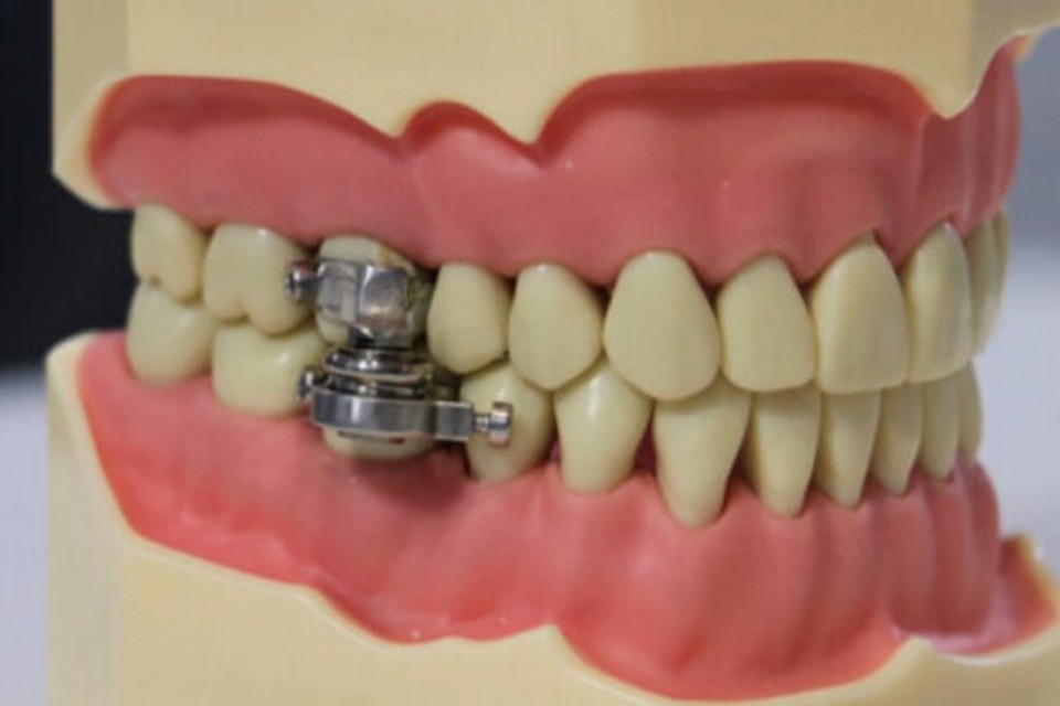 Вот так выглядит замок для рта. Фото: Медицина и Наука.